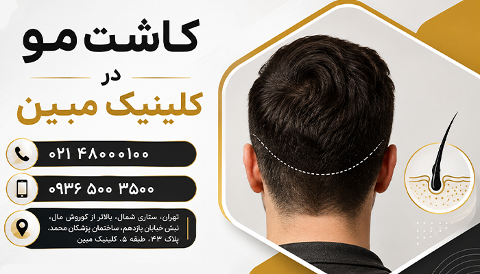 بنر کاشت مو در کلینیک مبین