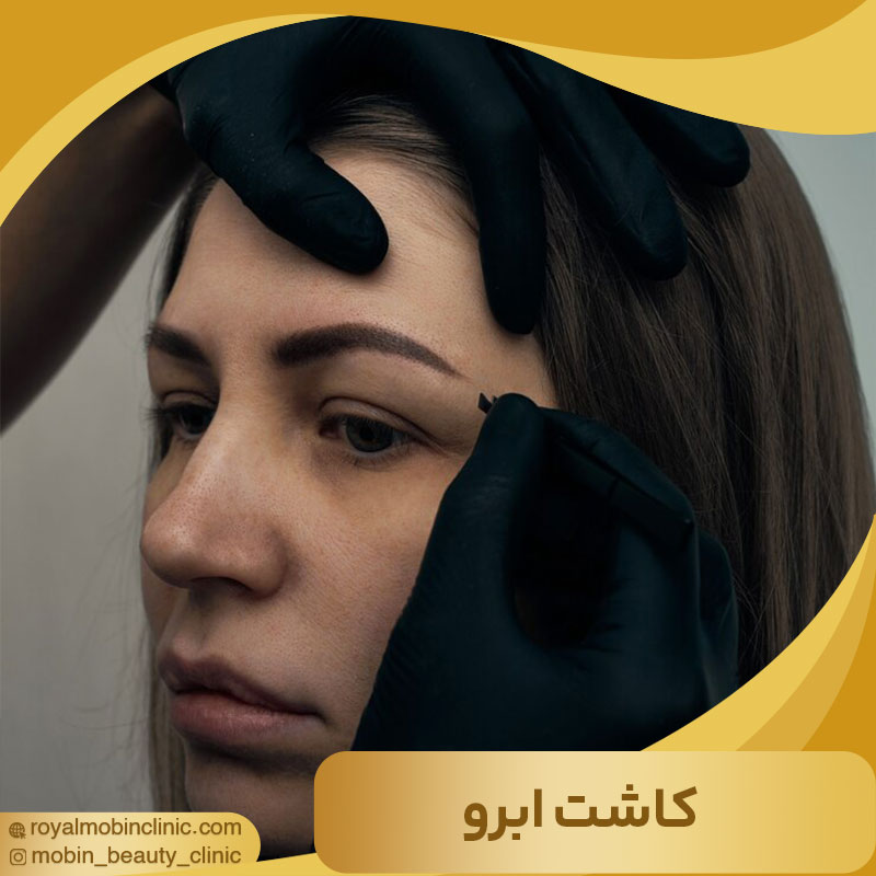 کاشت ابرو