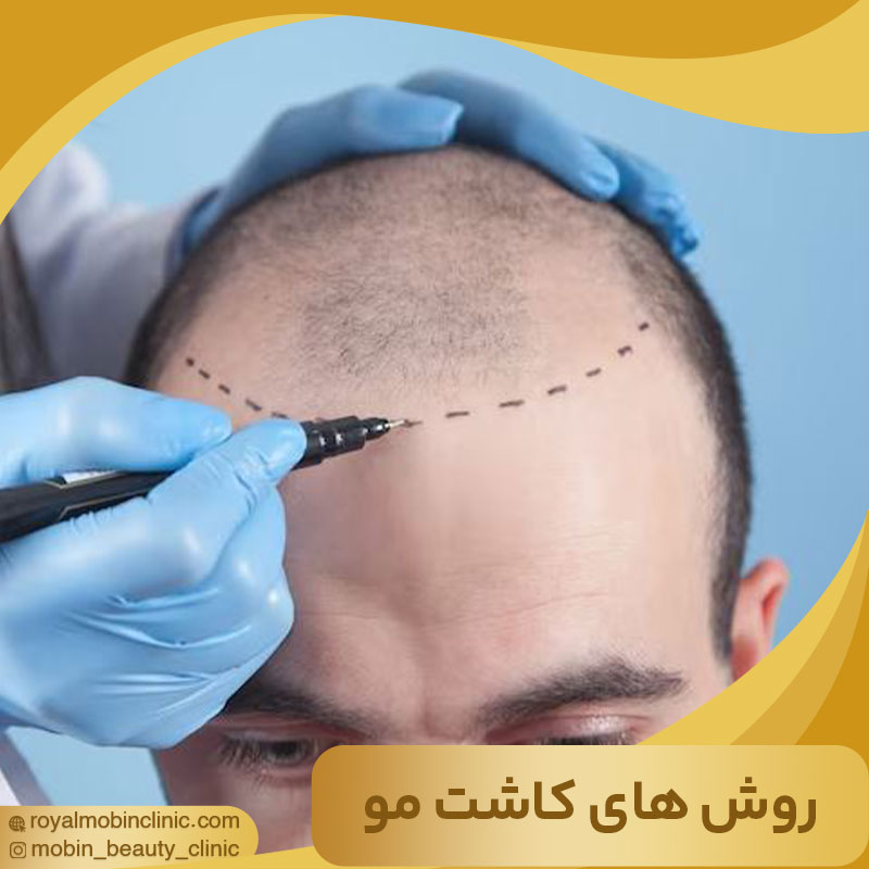 روش های کاشت مو