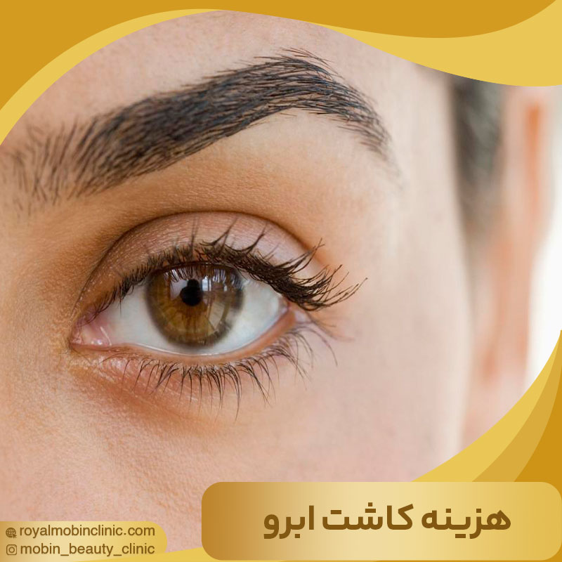 هزینه کاشت ابرو 