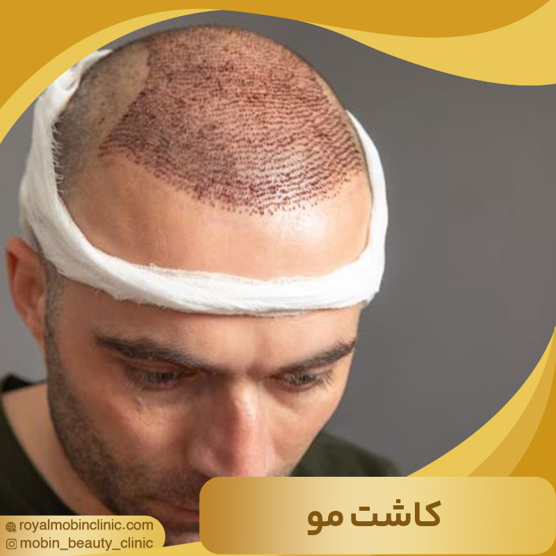 کاشت مو