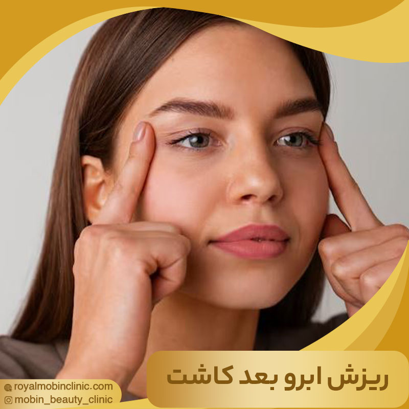 ریزش ابرو بعد از کاشت