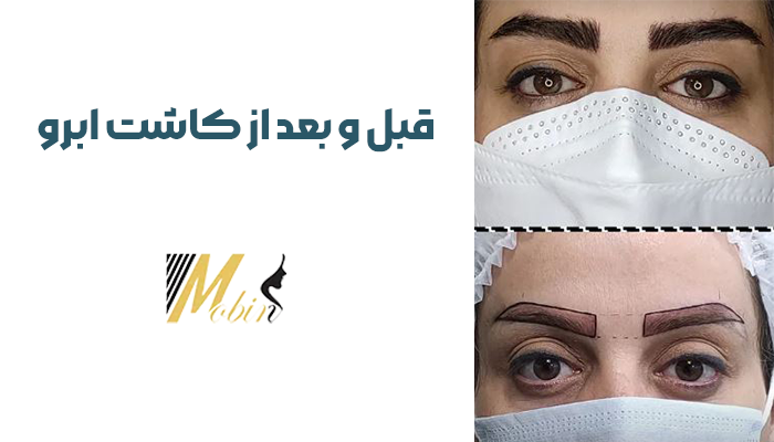 قبل و بعد از کاشت ابرو