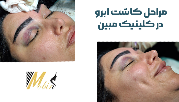 مراحل کاشت ابرو در کلینیک مبین