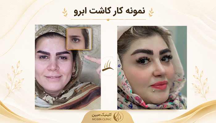 نمونه کار کاشت ابرو