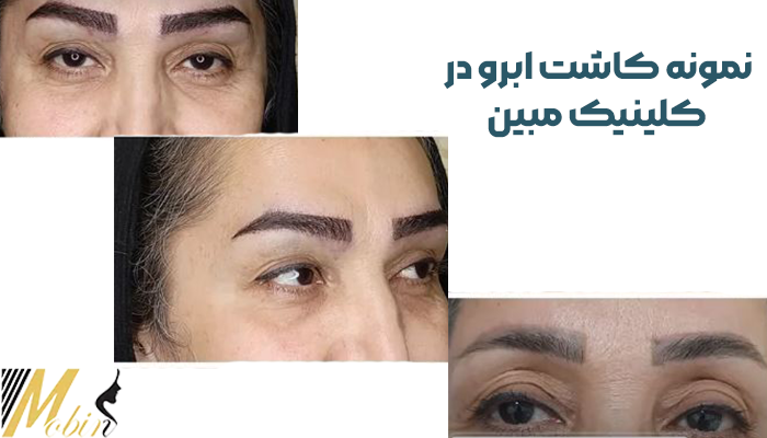 نمونه کاشت ابرو 3