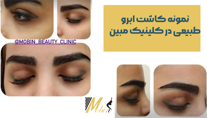 نمونه کاشت ابرو طبیعی در کلینیک مبین