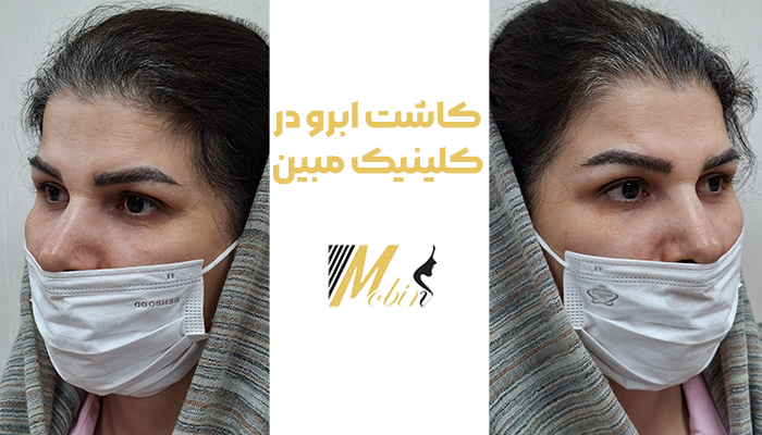 کاشت ابرو در کلینیک مبین