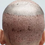 کاشت مو به روش FUT
