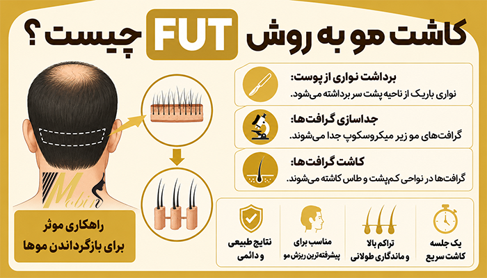 کاشت مو به روش FUT چیست؟