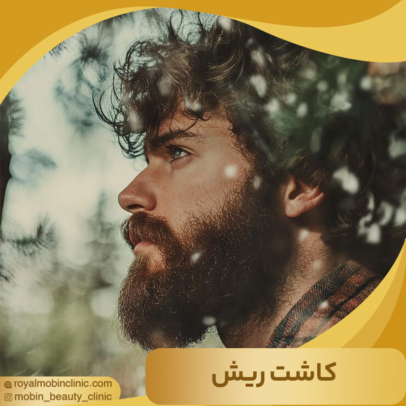 کاشت ریش