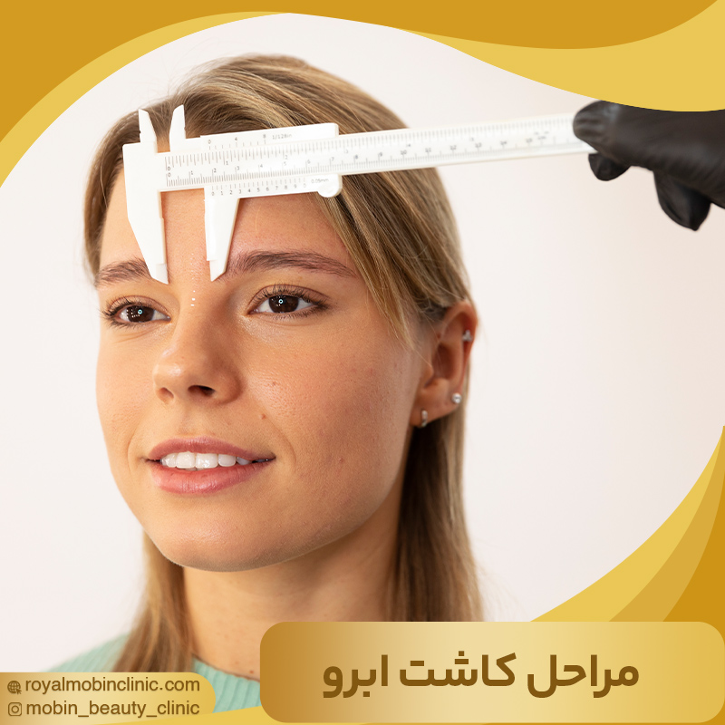 مراحل کاشت ابرو