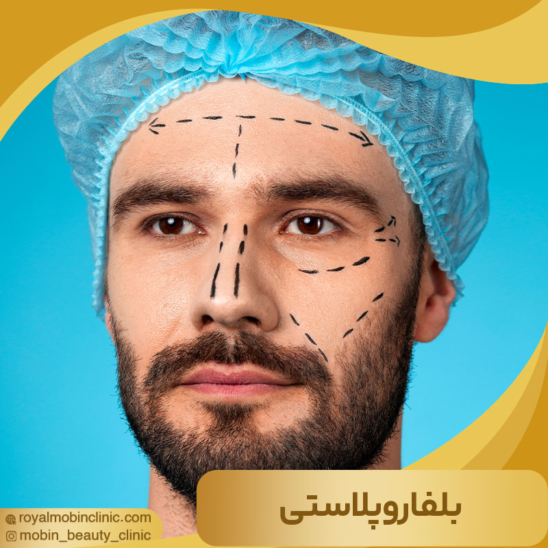 بلفاروپلاستی چیست؟