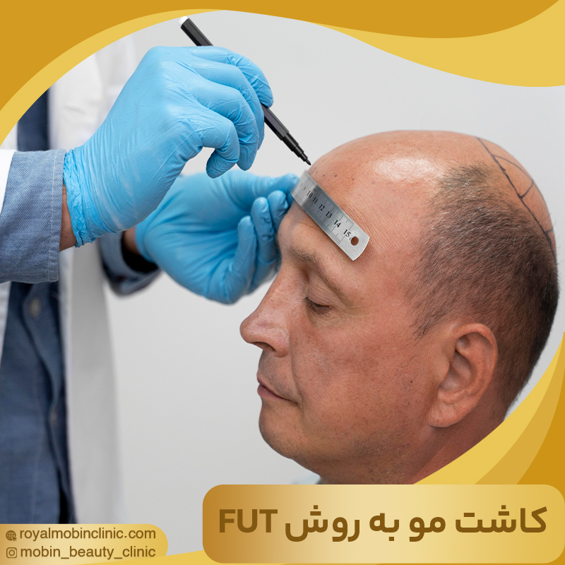 کاشت مو به روش FUT