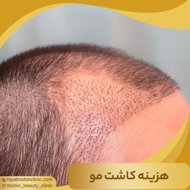 هزینه کاشت مو