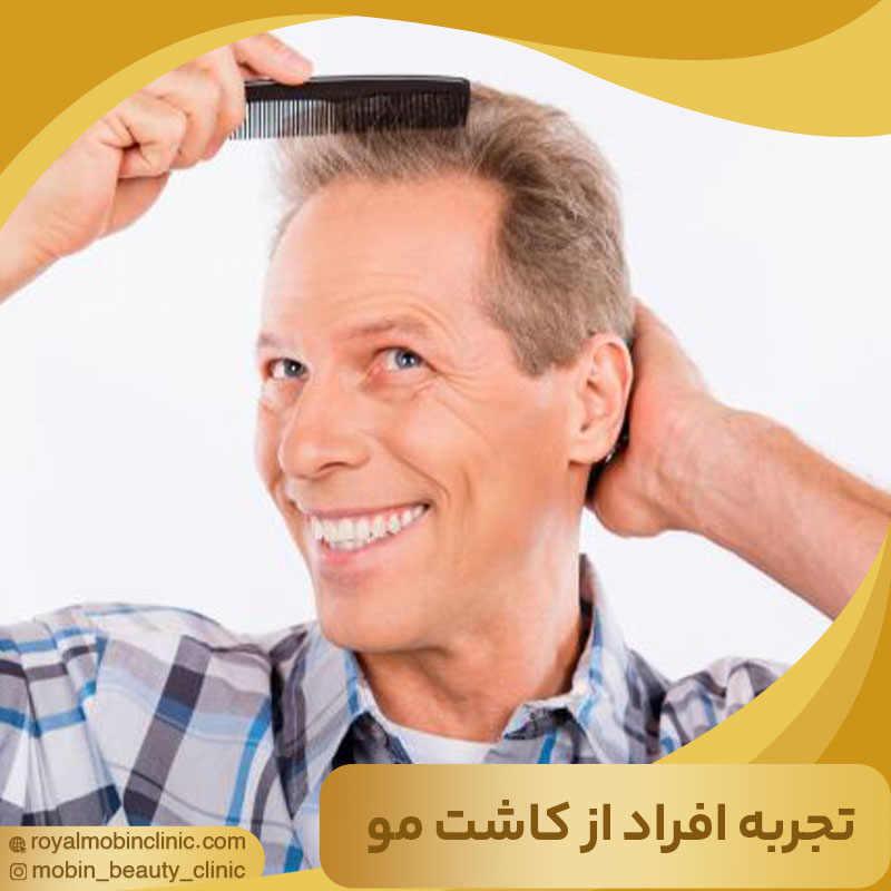 تجربه افراد از کاشت مو
