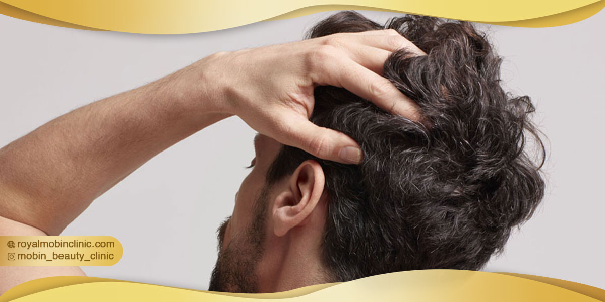 کاشت مو با روش BHT برای چه کسانی مناسب است؟