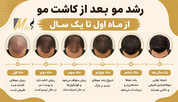 رشد مو بعد از کاشت مو از ماه اول تا یک سال