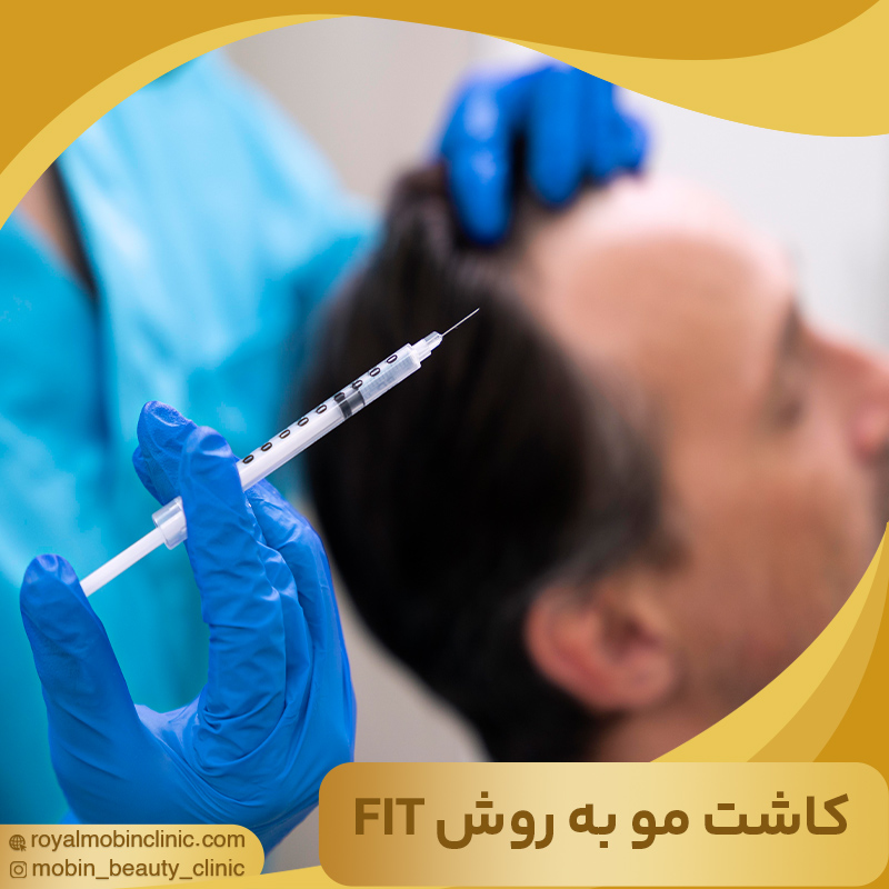 کاشت مو به روش FIT