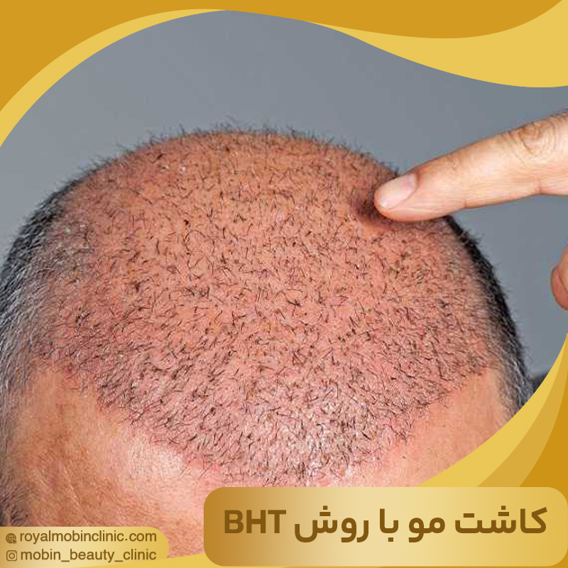 کاشت مو با روش BHT