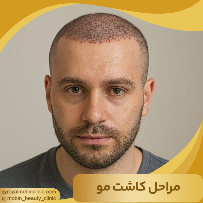 مراحل کاشت مو