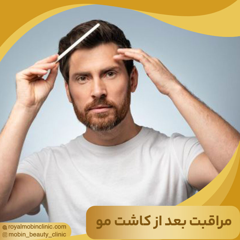 مراقبت های بعد از کاشت مو
