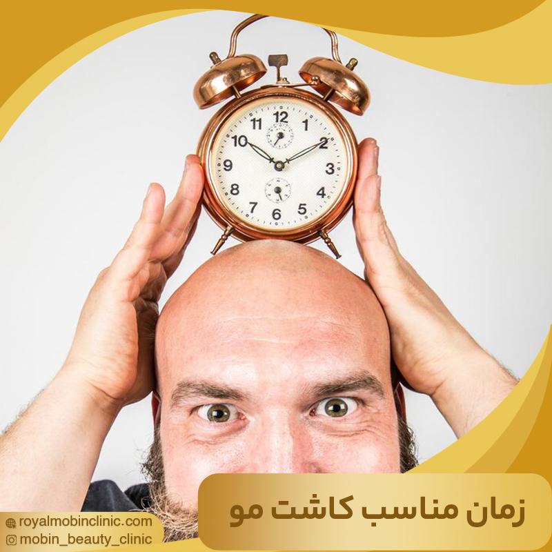 زمان مناسب برای کاشت مو