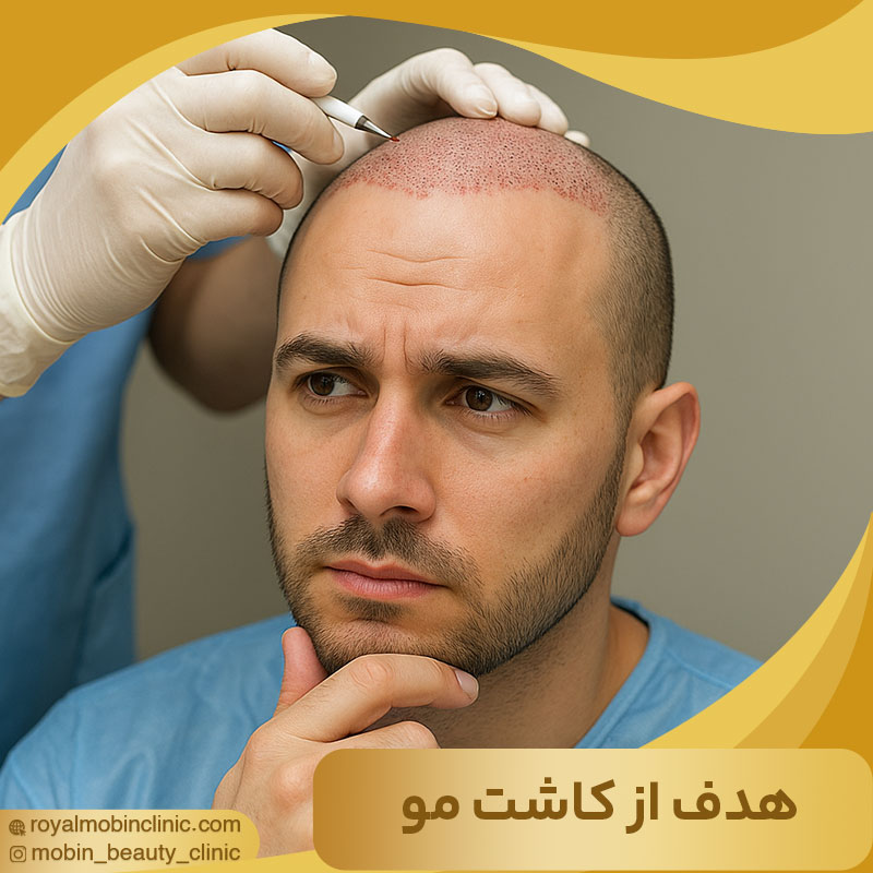 هدف از کاشت مو
