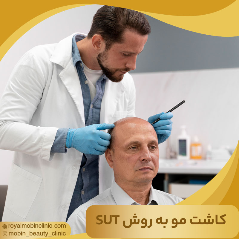 کاشت مو به روش SUT