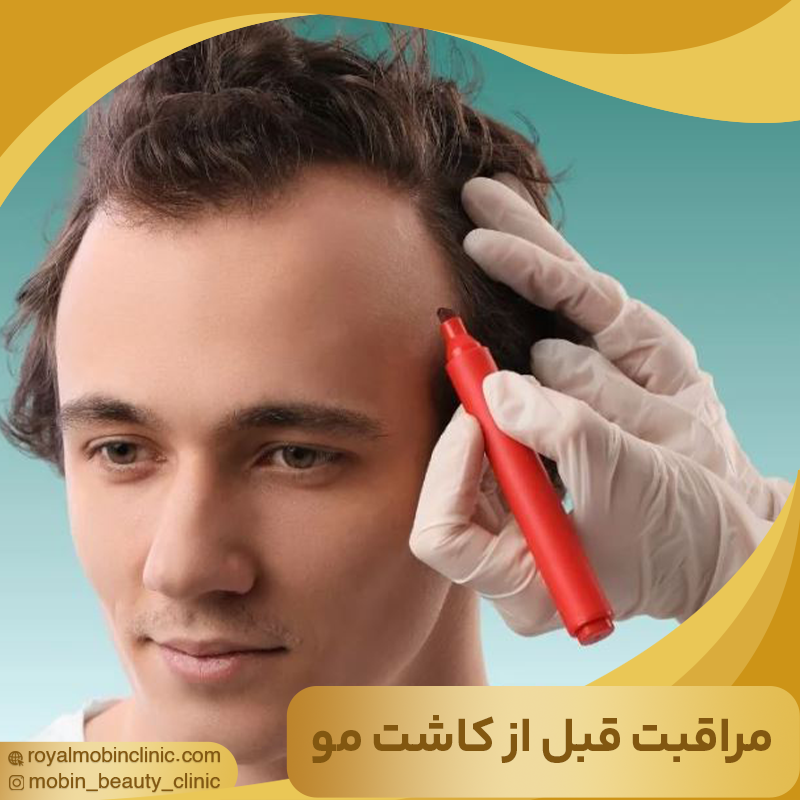 مراقبت های قبل از کاشت مو