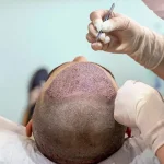 مراقبت های بعد از کاشت مو