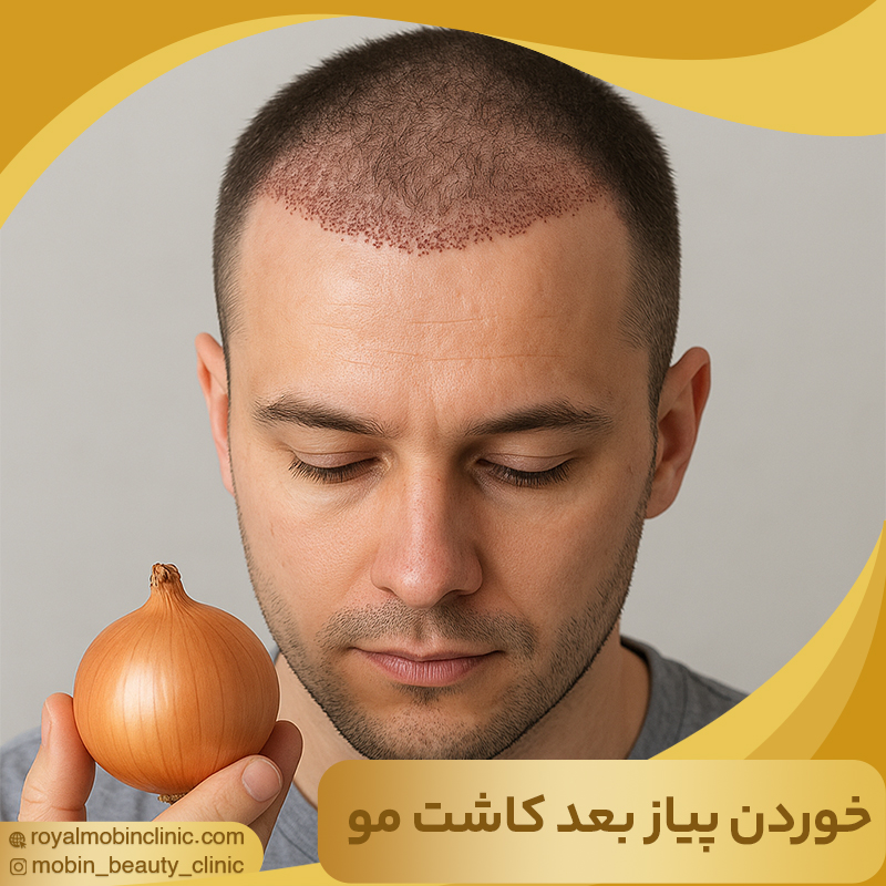 خوردن پیاز بعد از کاشت مو