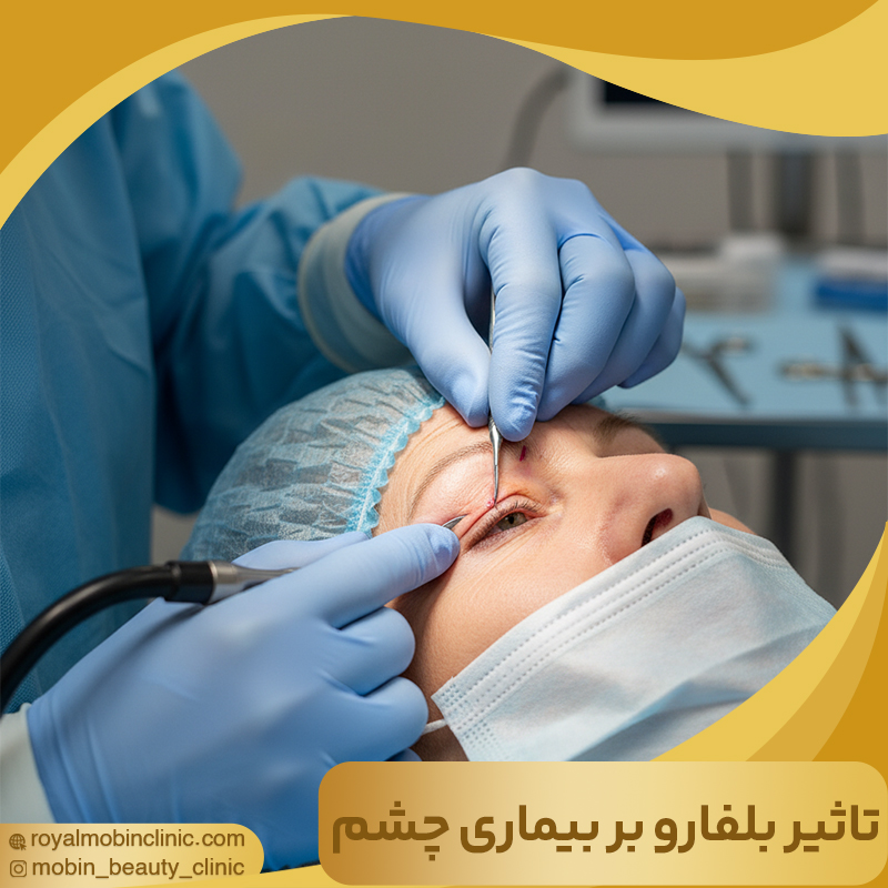 تاثیر بلفاروپلاستی در بیماری چشم