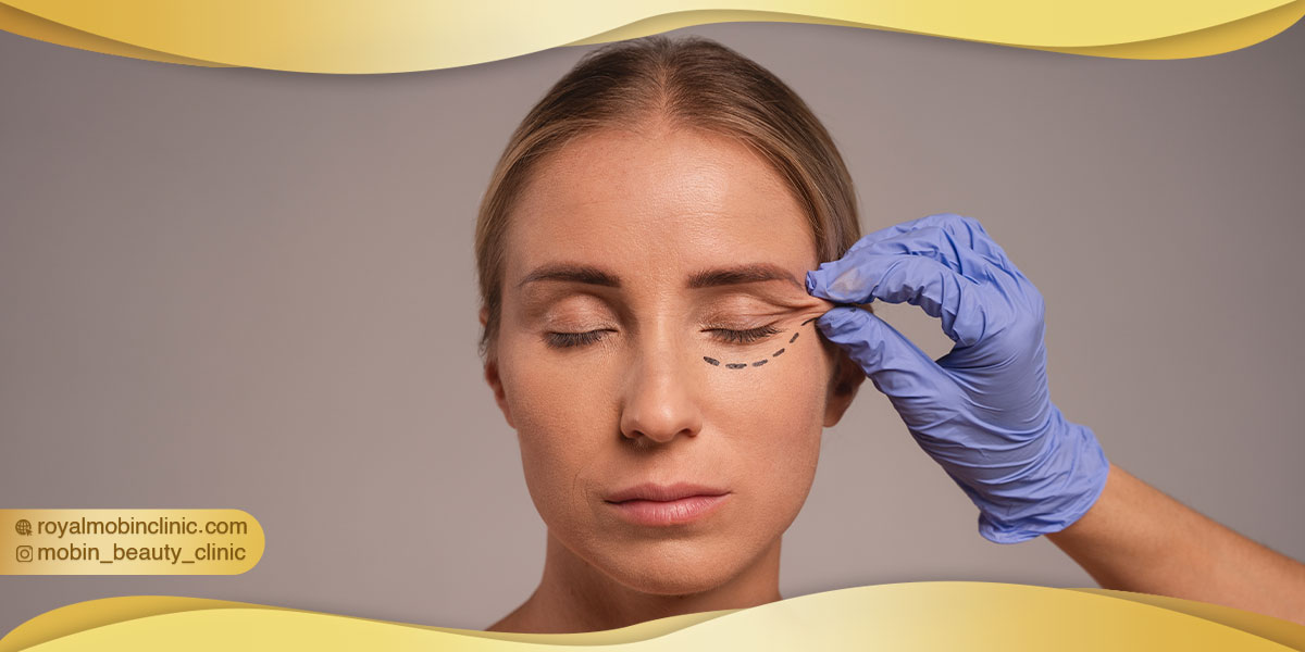 مراحل انجام لیفت شقیقه