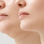 عوارض لیپوفیس