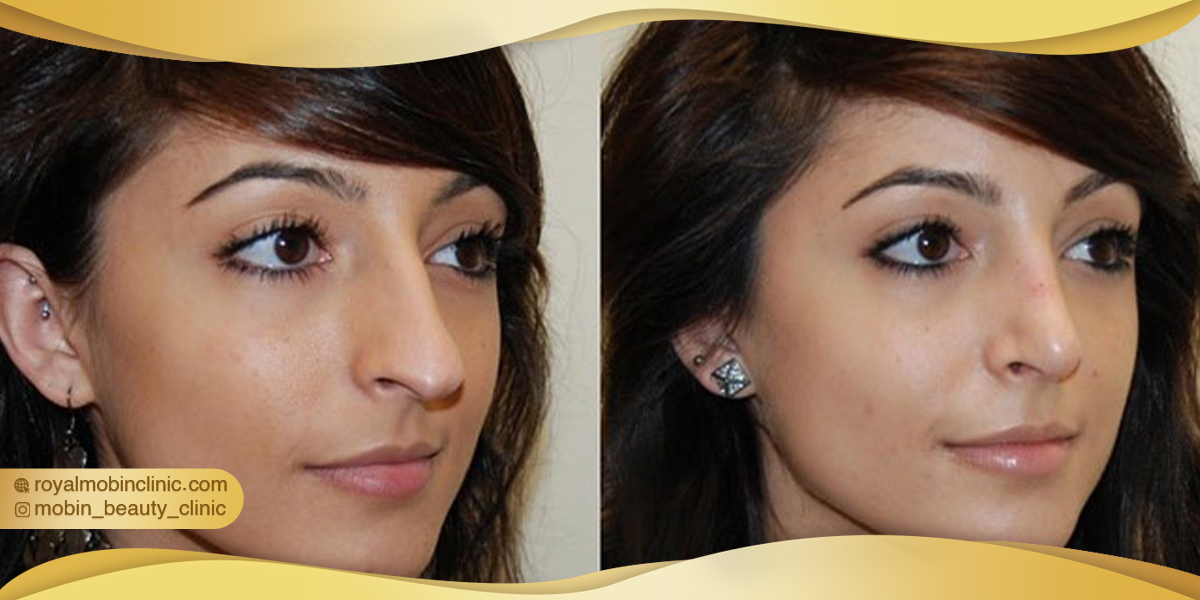 مراحل مقدماتی رینوپلاستی