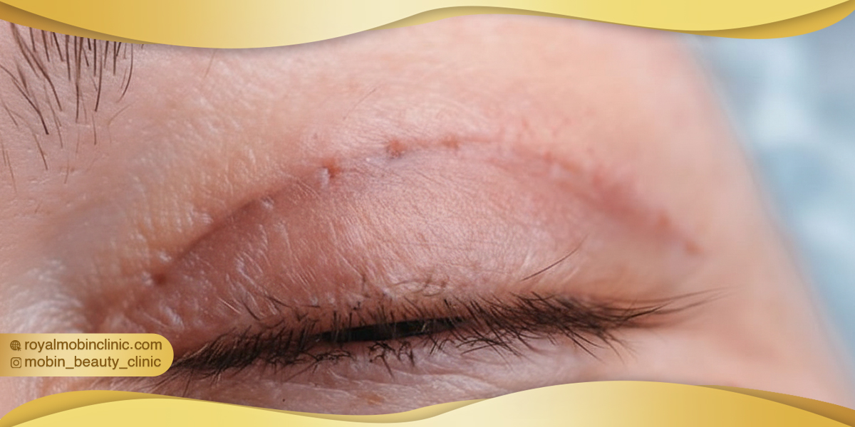 درمان خانگی جای بخیه بلفاروپلاستی