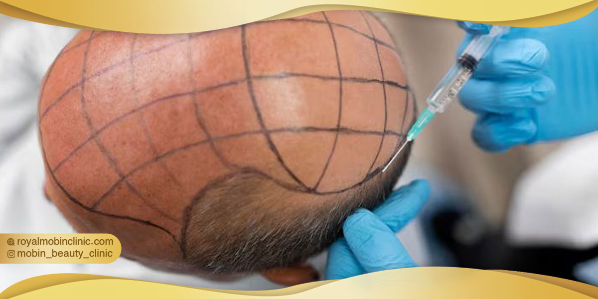 ویژگی های کاشت مو به روش FUE