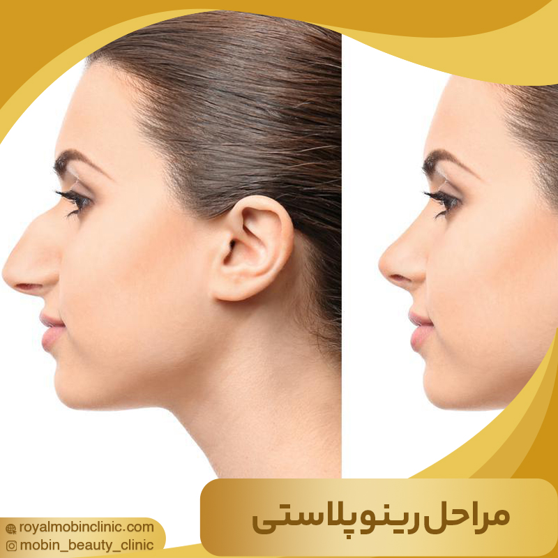 مراحل رینوپلاستی