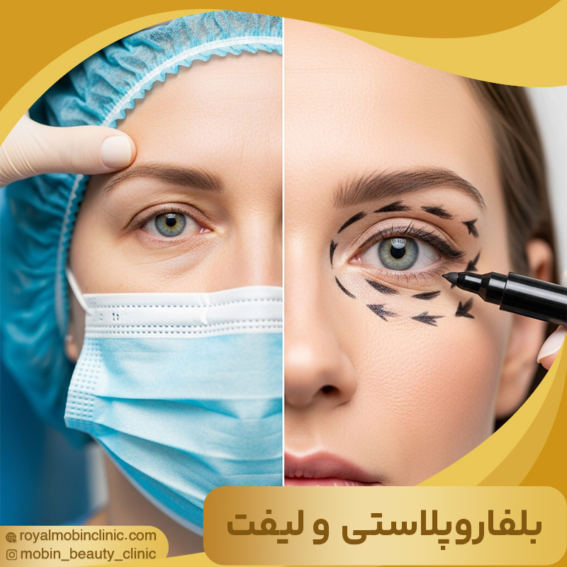 مقایسه بلفاروپلاستی و لیفت صورت