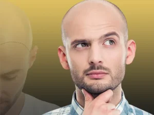 کاشت مو به روش FUE