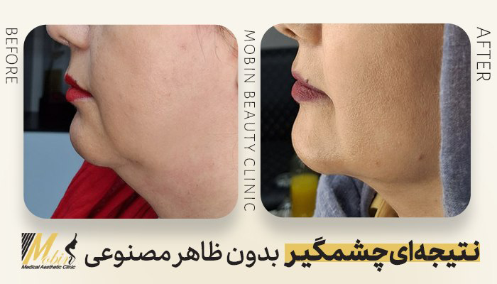 قبل و بعد لیپوفیس