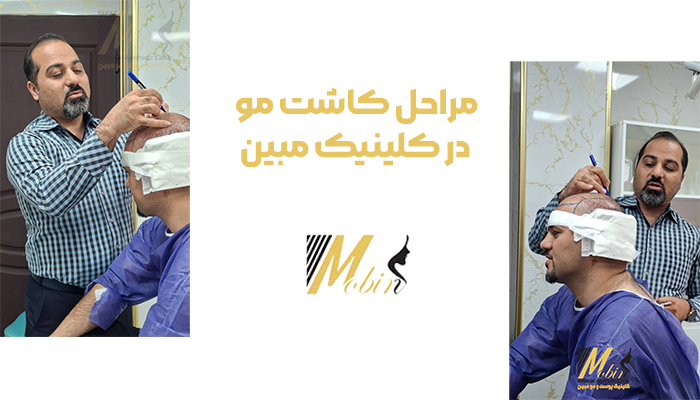 مراحل کاشت مو در کلینیک مبین