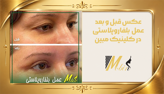 عکس قبل و بعد بلفاروپلاستی