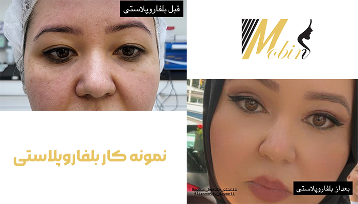 نمونه کار بلفاروپلاستی