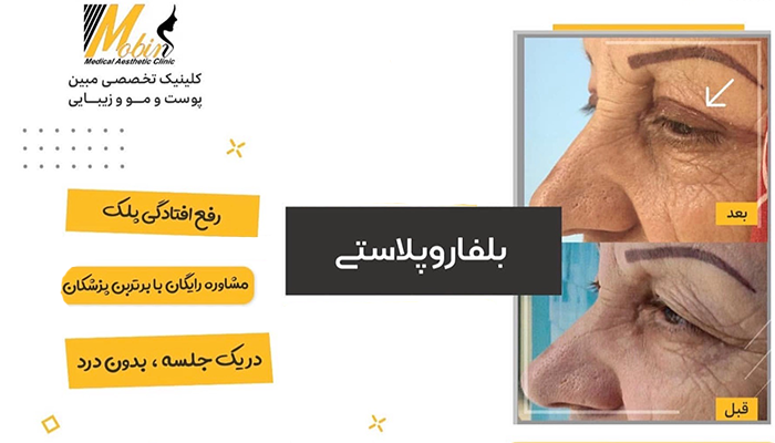 نمونه کار بلفاروپلاستی