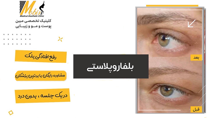نمونه کار بلفاروپلاستی
