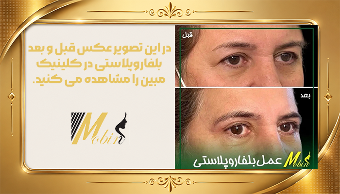 نمونه کار بلفاروپلاستی