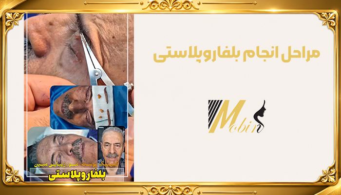 مراحل انجام بلفاروپلاستی