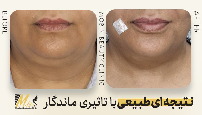 نمونه کار لیپوفیس